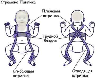 Стремена Павлика на пластиковых застежках Ортос Плюс, модель ПИО-05, размер 0