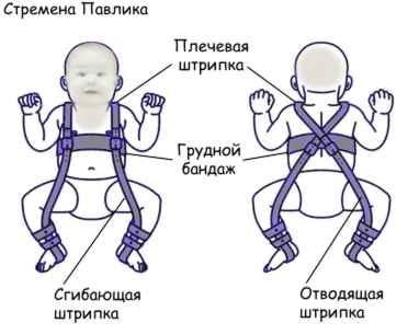 Стремена Павлика на пластиковых застежках Ортос Плюс, модель ПИО-05, размер 4