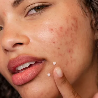 Гель-крем Dermalogica Clear Start Post Breakout Fix для лікування плям після висипу, 15 мл